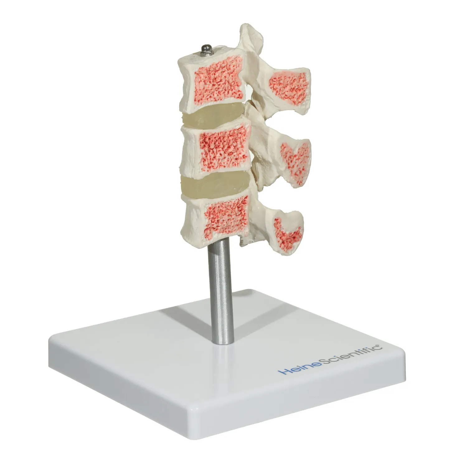 דגם אוסטאופורוזיס מקצועי - Osteoporosis Model להדגמת חוליות