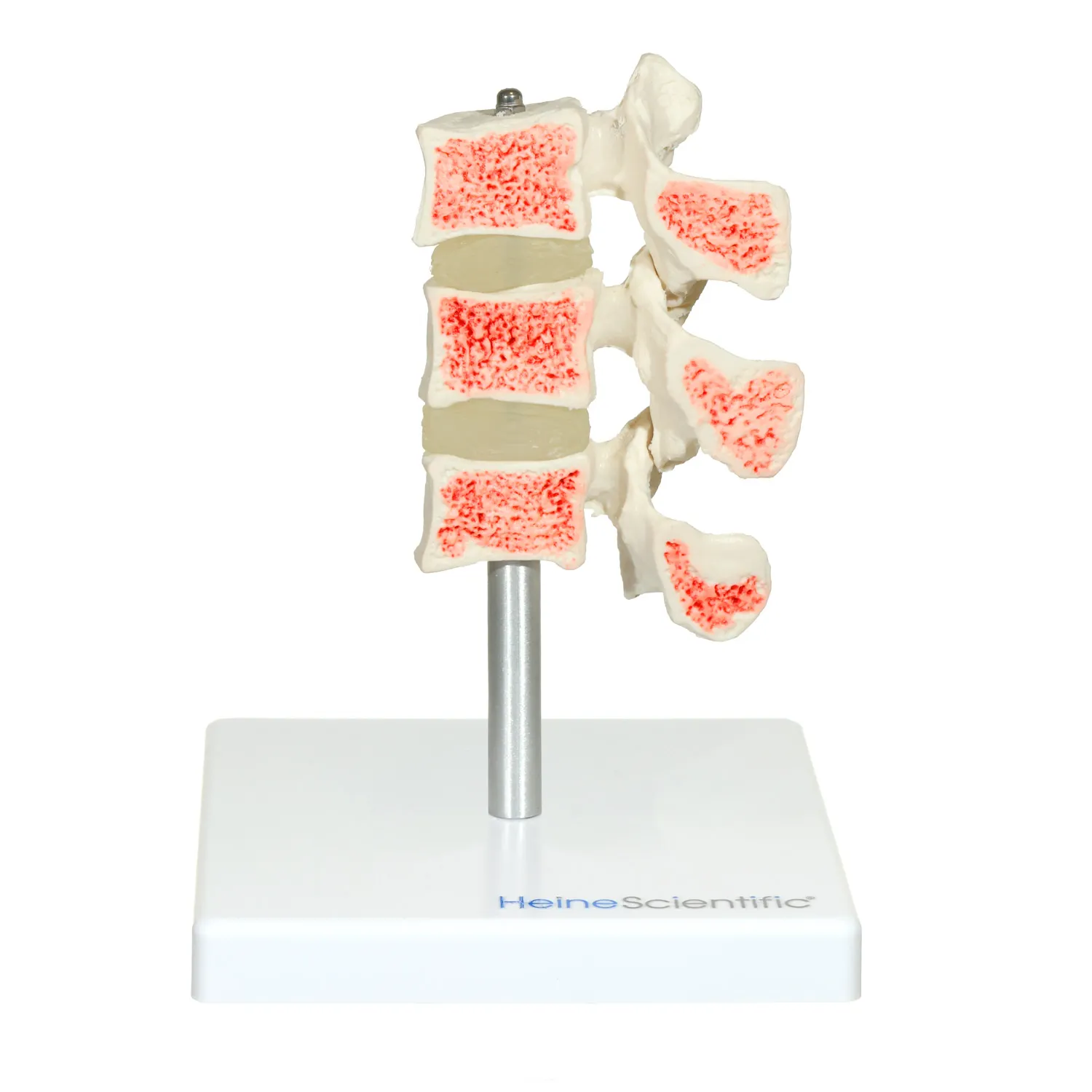 דגם אוסטאופורוזיס מקצועי - Osteoporosis Model להדגמת חוליות – תמונה 2