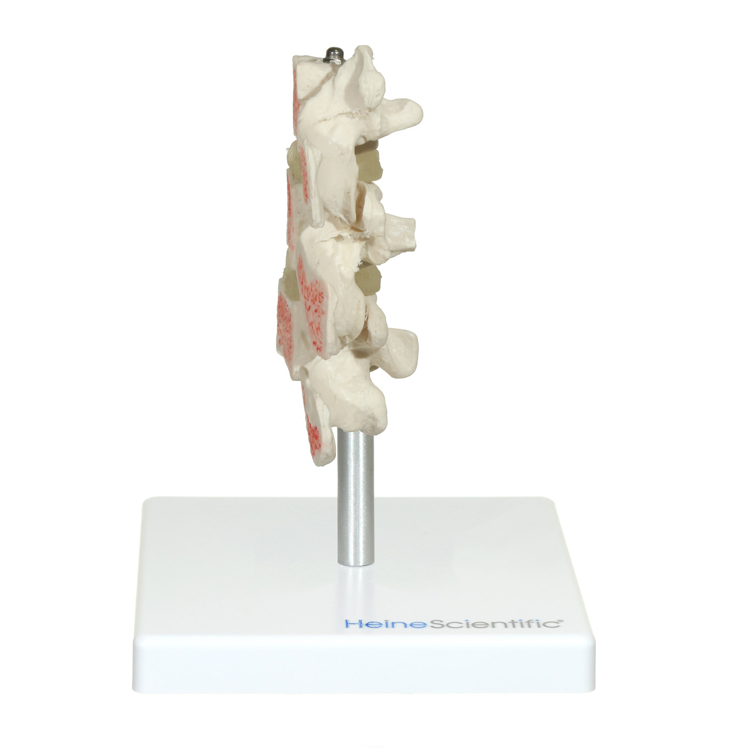 דגם אוסטאופורוזיס מקצועי - Osteoporosis Model להדגמת חוליות – תמונה 3